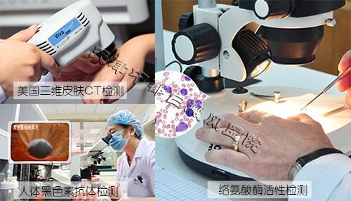 白癜風檢查
