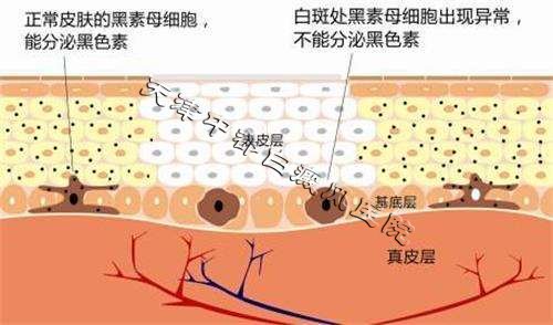 “調免促酶·今秋告白”白癜風公益援助活動