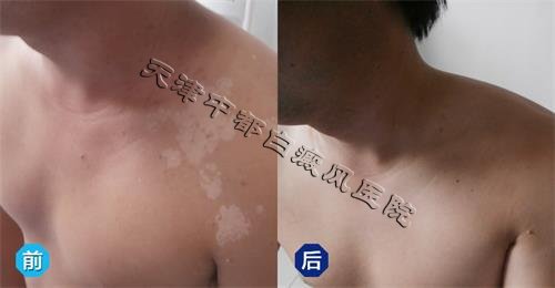 白癜風復發擴散、久治不愈有哪些原因？