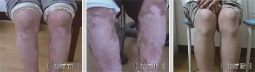 腿部白癜風的擴散誘因有哪些呢？