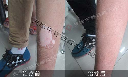 腿部白癜風的擴散誘因有哪些呢？