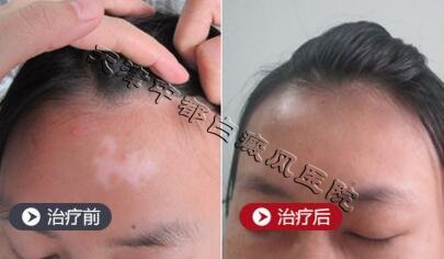 白癜風(fēng)的常見原因有哪些？