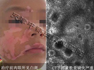 白癜風(fēng)的臨床癥狀有哪些呢？