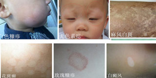 兒童白癜風癥狀有哪些呢？