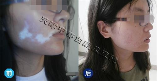 白癜風(fēng)是怎樣引起的呢?