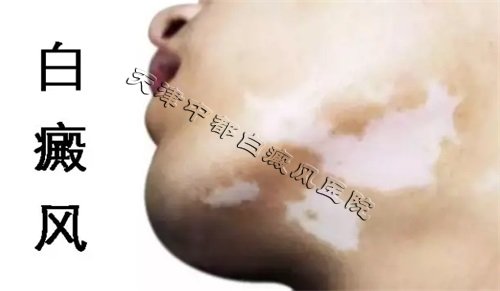 早期白癜風癥狀及圖片