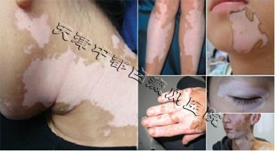早期白癜風癥狀及圖片