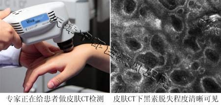 身上長小白斑是白癜風嗎？