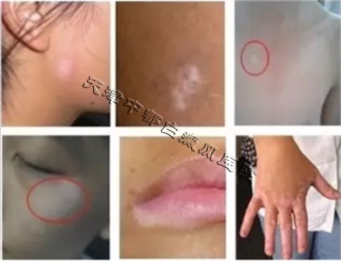 身上長小白斑是白癜風嗎？