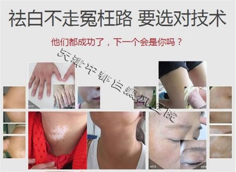 生活中白癜風會不會遺傳呢?
