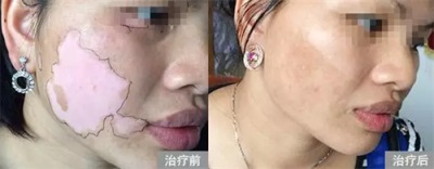 白癜風(fēng)有效的治療方法是什么呢？