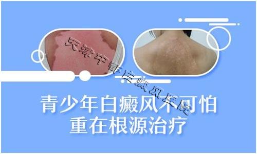 關(guān)愛兒童青少年褪白基金會公益項目走進中都