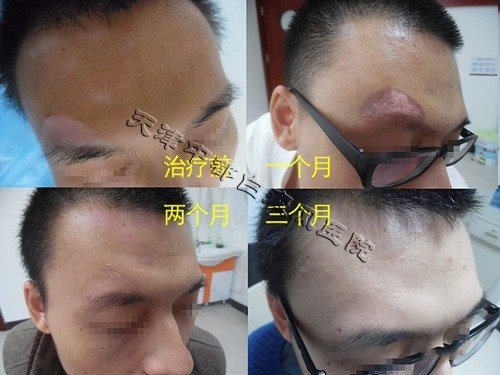 常見白癜風(fēng)的原因有哪些呢?