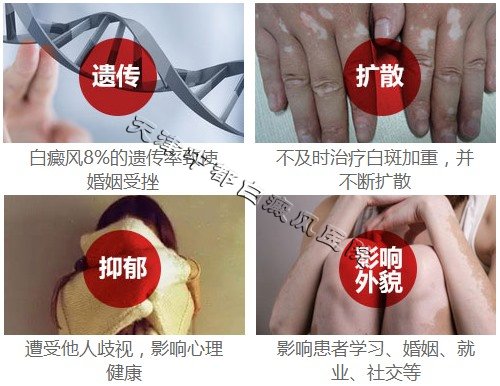 得了白癜風的危害有哪些表現(xiàn)呢？