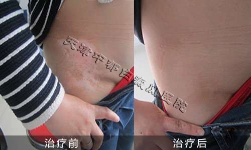 春季萬物復蘇，小心白癜風的復發